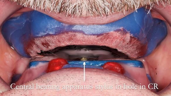 Newsletter 78: What do Clark Gable and a Locator® overdenture have in common?