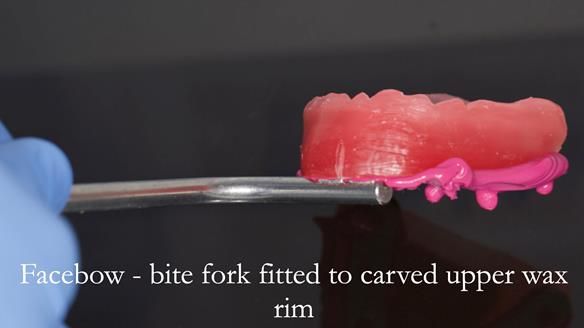 Visit 4 The bite fork is attached to the wax rim is be used to mount the upper working cast on the articulator