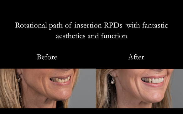 Figure 85 Before and after photos with cobalt chromium based partial dentures with Schottlander Enigmalife teeth