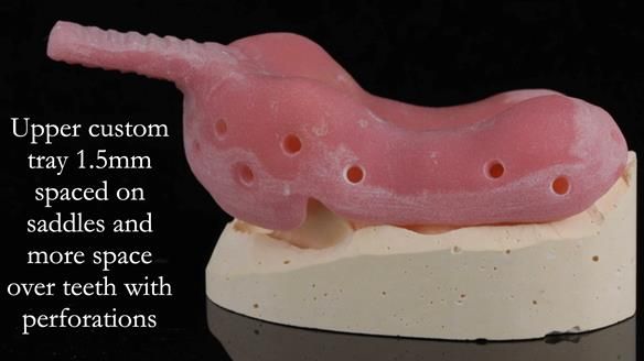 Finlay's Newsletter 60 Sylvia's upper Kennedy Class 2 Mod 1 metal based upper RPD