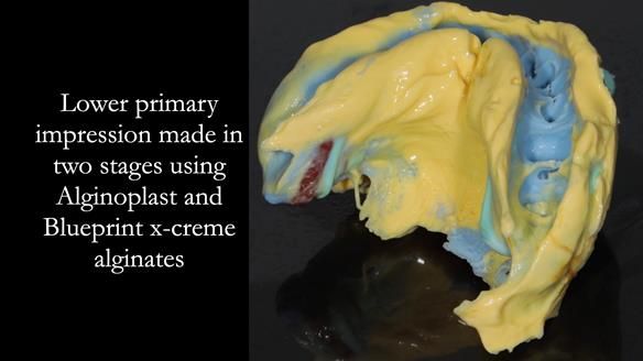 Finlay's Newsletter 61 provision of a lower unilateral free end saddle metal based partial denture for Joyce