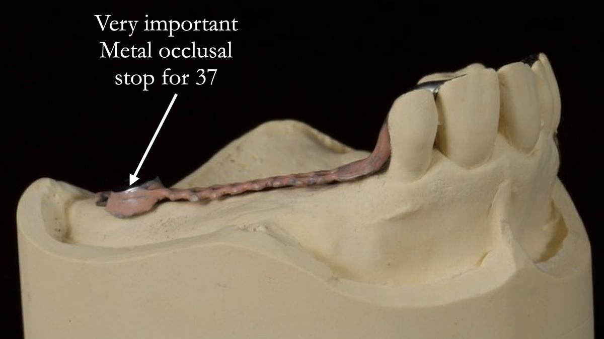 Newsletter 89 – Simon: A Challenging Kennedy Class II Division 1 Upper CoCr Partial Denture with a High Smile Line
