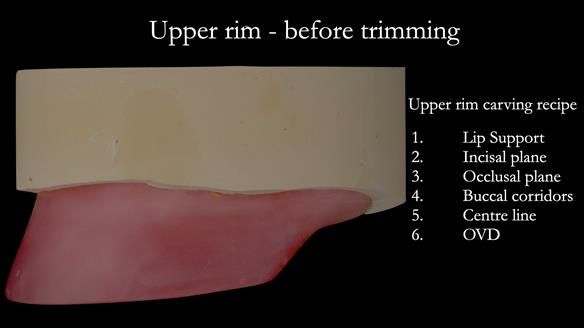 Complete denture Class II div 2 deep overbite Newsletter 39