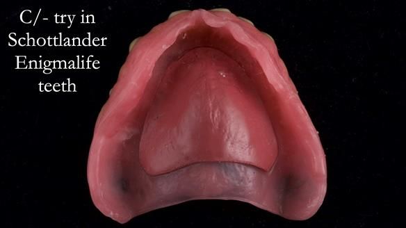 Newsletter 54 case presentation upper complete denture and lower Scandinavian designed hygienic partial denture for David