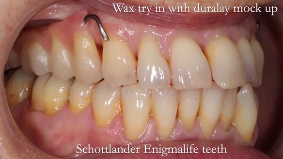 Newsletter 56 showing the making and fitting of a bilateral free end saddle upper removable partial denture (RPD) for patient with pemphigus
