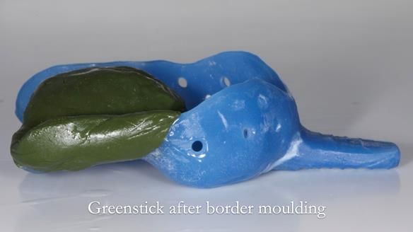 Finlay's Newsletter 64 case study - provision of a Kennedy class 2 metal based Scandinavian RPD for Ian