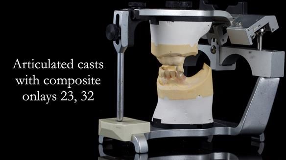 Newsletter 55 Provision of metal based partial dentures for Zephyrine with a repaired cleft lip and palate