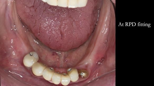 Ken – going downhill, first class