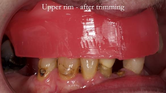 Newsletter 55 Provision of metal based partial dentures for Zephyrine with a repaired cleft lip and palate