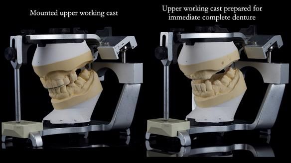 Newsletter 77: Jeremy’s case – immediate complete upper denture