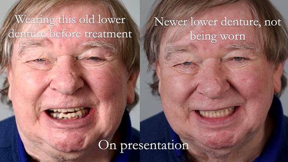 Newsletter 44 - extreme removable prosthodontics – engineering a super-strong and ultra-thin over denture