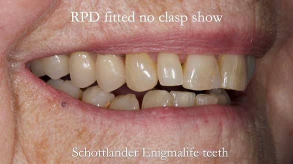 Finlay's Newsletter 60 Sylvia's upper Kennedy Class 2 Mod 1 metal based upper RPD