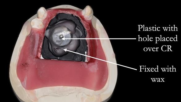 Finlay's Newsletter 59 Ultra hard partial dentures made for Gill