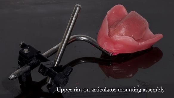 Newsletter 77: Jeremy’s case – immediate complete upper denture