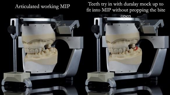 Finlay's Newsletter 61 provision of a lower unilateral free end saddle metal based partial denture for Joyce