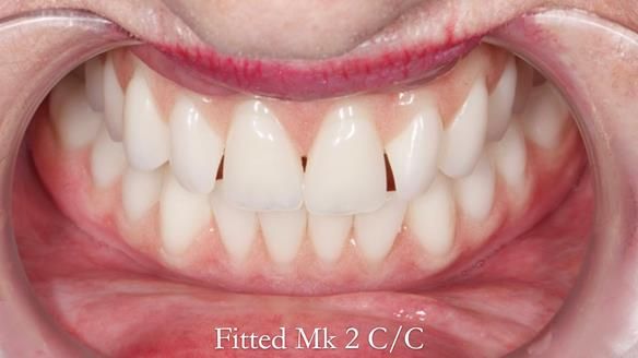 Replacing Madeline’s Complete denture FULL PROTOCOL