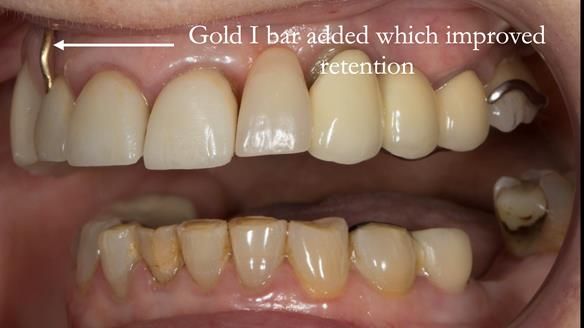 Newsletter 51 Managing Anne’s failing dentition with distal extension base RPD/Splint FULL PROTOCOL