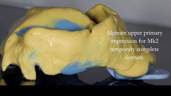 Newsletter 77: Jeremy’s case – immediate complete upper denture