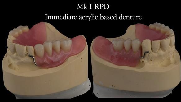 Finlay's Case Study Newsletter 40 - Immediate Mk 1 RPD to Definitive Mk 2 RPD - full protocol
