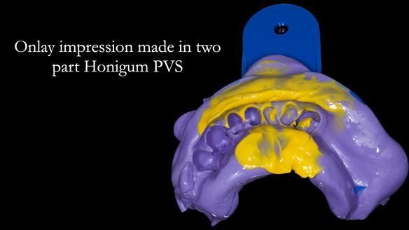 Newsletter 55 Provision of metal based partial dentures for Zephyrine with a repaired cleft lip and palate