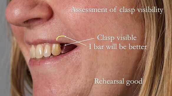 Solving Sue's failed implants with metal based RPD - full protocol Newsletter 43