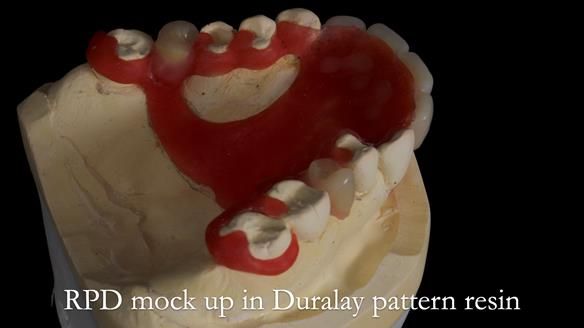 Newsletter 81 - Pam’s Story — how a partial denture changed her life (+ live walkthrough this Thursday)