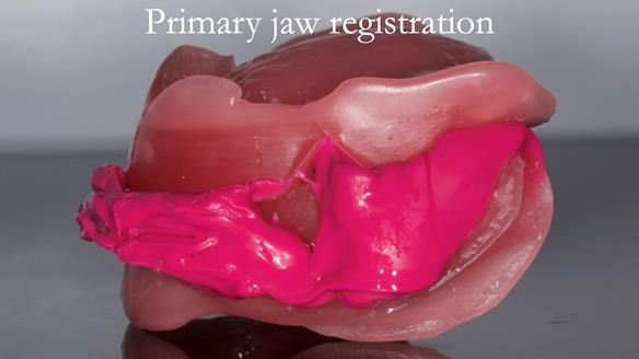 Managing poor implant positioning with complete dentures and Locator attachments - full protocol Newsletter 41