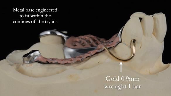 Finlay's Newsletter 60 Sylvia's upper Kennedy Class 2 Mod 1 metal based upper RPD