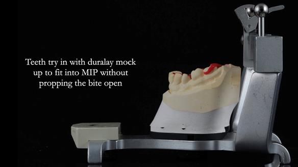 Finlay's Newsletter 61 provision of a lower unilateral free end saddle metal based partial denture for Joyce