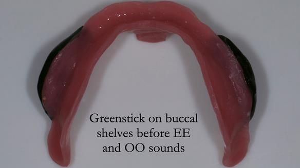 Complete denture Class II div 2 deep overbite Newsletter 39