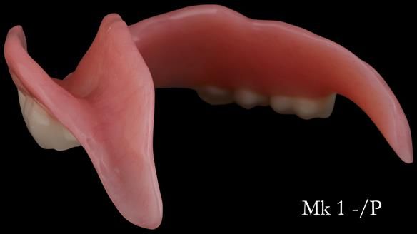 Newsletter 52 Managing Jo’s failing dentition with extractions and Mk 1/Mk 2 complete upper dentures and lower partial dentures FULL PROTOCOL