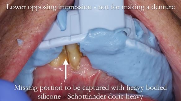 Newsletter 54 case presentation upper complete denture and lower Scandinavian designed hygienic partial denture for David