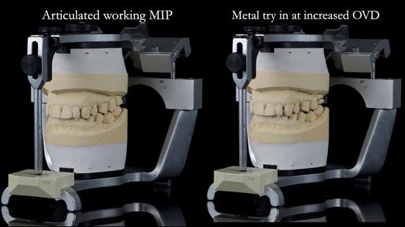 Finlay's Newsletter 64 case study - provision of a Kennedy class 2 metal based Scandinavian RPD for Ian