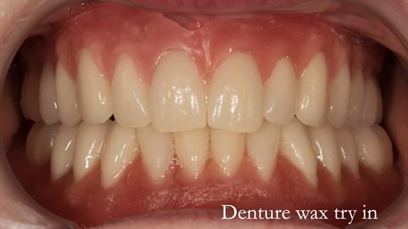 Newsletter 75: Marion’s case - Step-by-step complete denture workflow