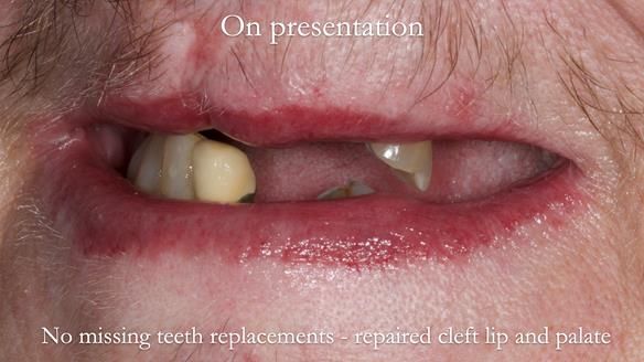 Newsletter 55 Provision of metal based partial dentures for Zephyrine with a repaired cleft lip and palate