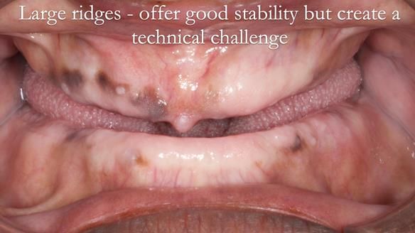 Newsletter 53 showing the making and fitting of ultra life-like dentures for Valena