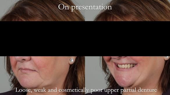 Finlay's Newsletter 58 Gasket upper partial denture for Zoe