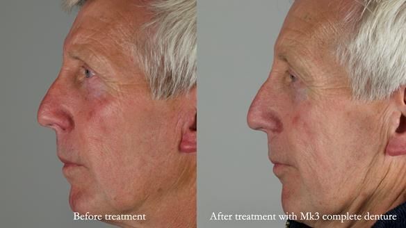 Newsletter 77: Jeremy’s case – immediate complete upper denture