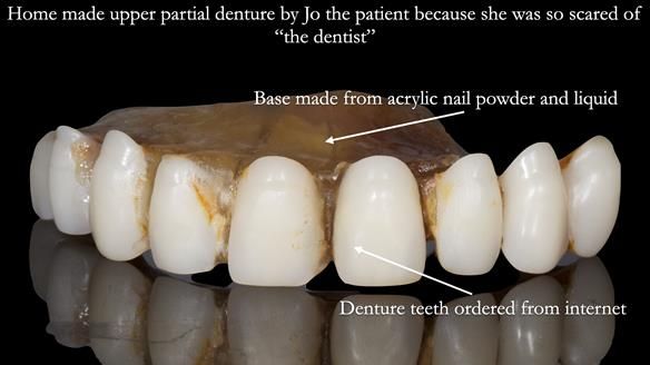 Newsletter 52 Managing Jo’s failing dentition with extractions and Mk 1/Mk 2 complete upper dentures and lower partial dentures FULL PROTOCOL