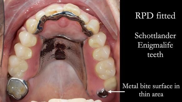 Finlay's Newsletter 60 Sylvia's upper Kennedy Class 2 Mod 1 metal based upper RPD