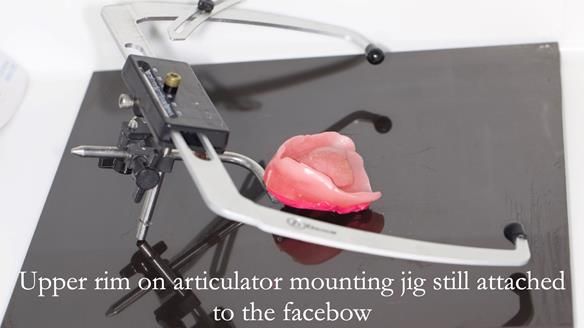 Newsletter 54 case presentation upper complete denture and lower Scandinavian designed hygienic partial denture for David