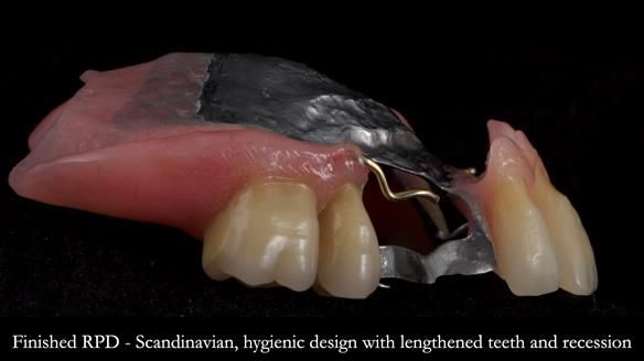 Finlay's Newsletter 59 Ultra hard partial dentures made for Gill