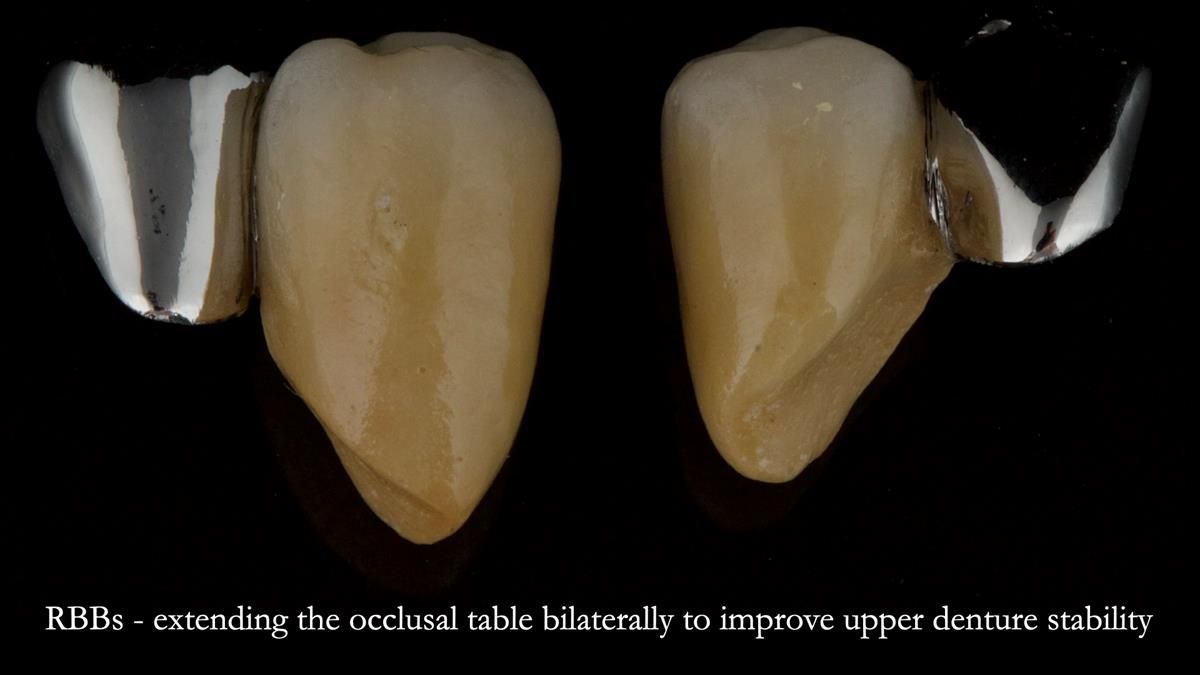 Newsletter 87 – Father Peter: A Partial Denture that needed Minor Miracle