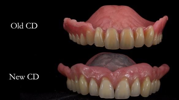 Finlay's Newsletter 62 provision of extractions and metal based complete dentures for Rafique