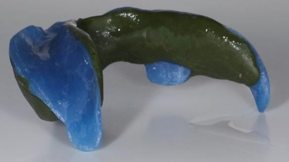 Newsletter 83: Sheila’s Complete Denture Success