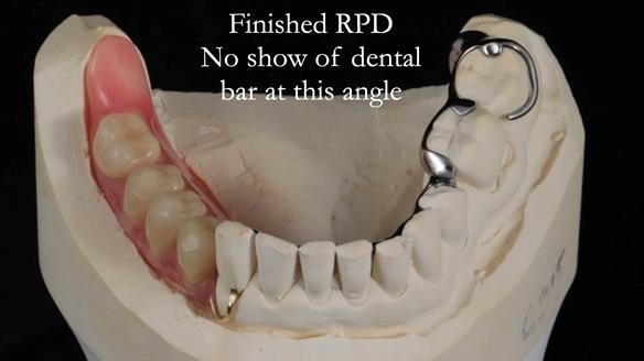 Finlay's Newsletter 61 provision of a lower unilateral free end saddle metal based partial denture for Joyce