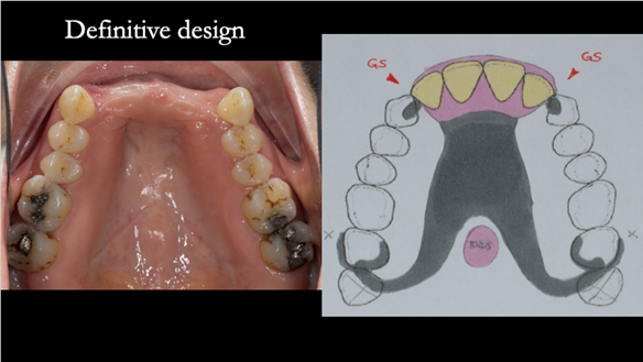 Figure 54 definitive upper denture design