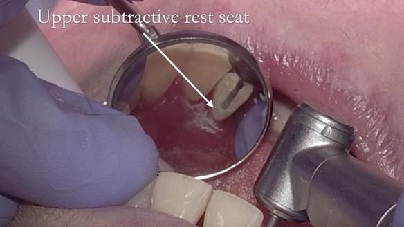 Finlay's Case Study Newsletter 40 - Immediate Mk 1 RPD to Definitive Mk 2 RPD - full protocol