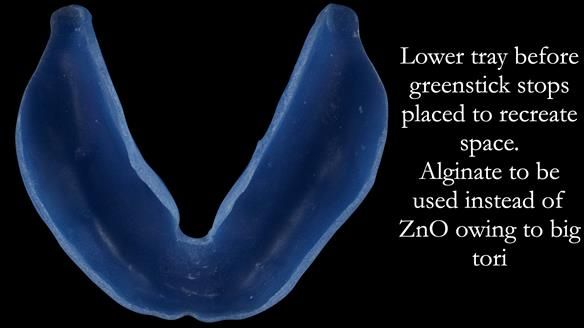 Newsletter 53 showing the making and fitting of ultra life-like dentures for Valena