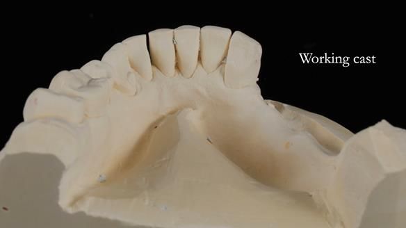 Finlay's Newsletter 61 provision of a lower unilateral free end saddle metal based partial denture for Joyce